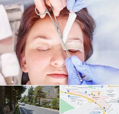 جراحی پلک افتاده در مهرویلا کرج