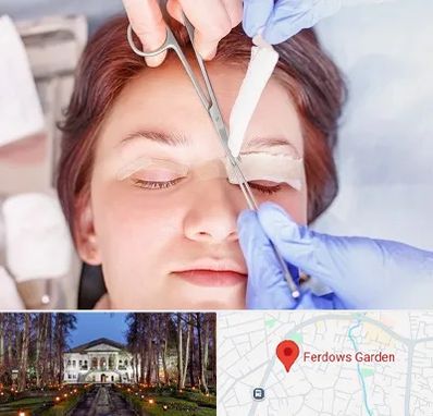 جراحی پلک افتاده در باغ فردوس