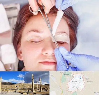 جراحی پلک افتاده در مرودشت