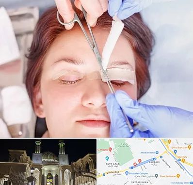 جراحی پلک افتاده در زرگری شیراز