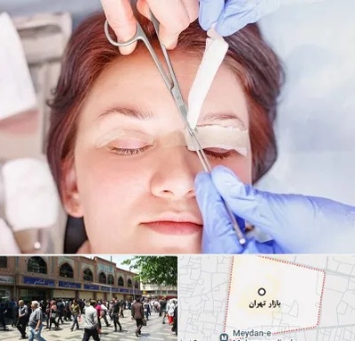 جراحی پلک افتاده در بازار تهران