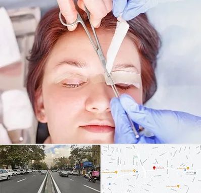 جراحی پلک افتاده در دولت