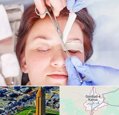 جراحی پلک افتاده در گنبد کاووس