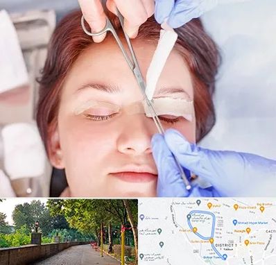 جراحی پلک افتاده در فلکه گاز رشت