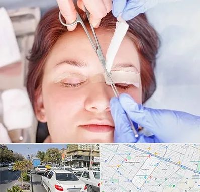 جراحی پلک افتاده در مفتح مشهد