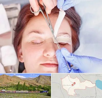 جراحی پلک افتاده در خاش