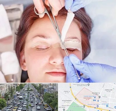 جراحی پلک افتاده در گلشهر کرج