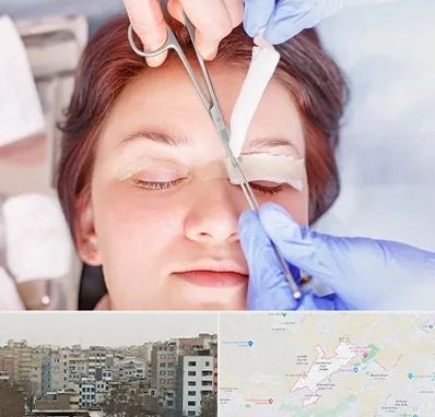 جراحی پلک افتاده در محمد شهر کرج