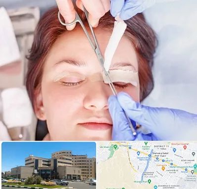 جراحی پلک افتاده در صیاد شیرازی مشهد