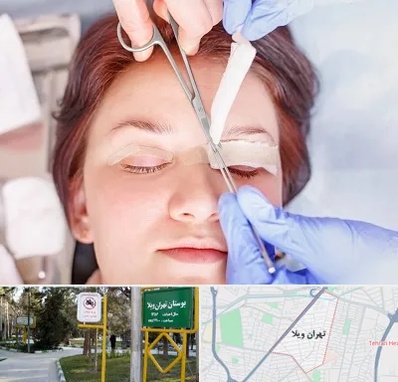 جراحی پلک افتاده در تهران ویلا