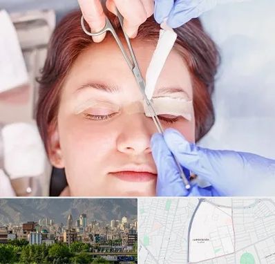 جراحی پلک افتاده در جمشیدیه