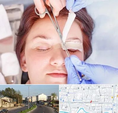 جراحی پلک افتاده در ضیابری رشت