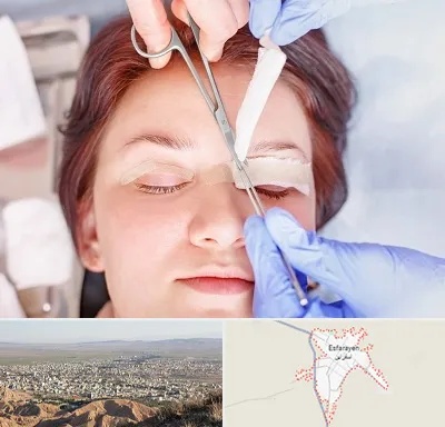 جراحی پلک افتاده در اسفراین