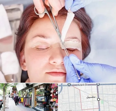 جراحی پلک افتاده در سلسبیل