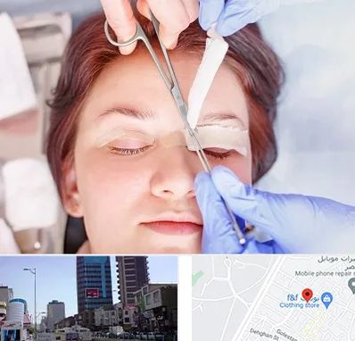 جراحی پلک افتاده در چهارراه طالقانی کرج