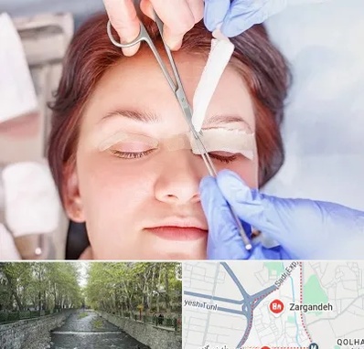 جراحی پلک افتاده در زرگنده