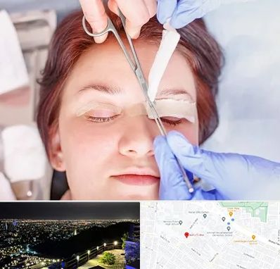 جراحی پلک افتاده در هفت تیر مشهد