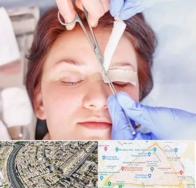 جراحی پلک افتاده در شهرک غرب مشهد