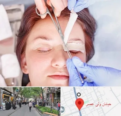 جراحی پلک افتاده در ولیعصر شهریار