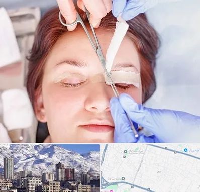 جراحی پلک افتاده در ازگل