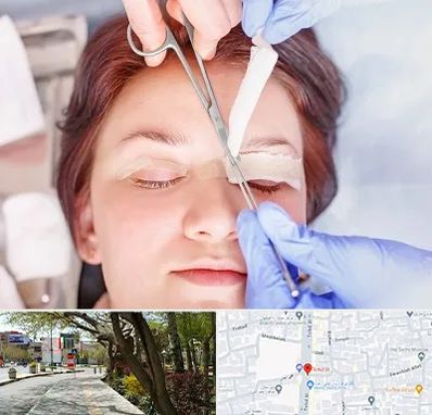 جراحی پلک افتاده در خیابان توحید اصفهان