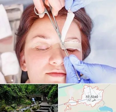جراحی پلک افتاده در علی آباد کتول