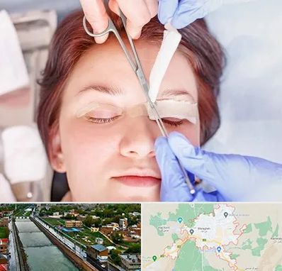 جراحی پلک افتاده در مراغه