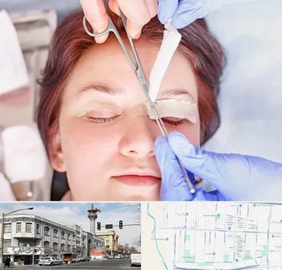 جراحی پلک افتاده در 17شهریور