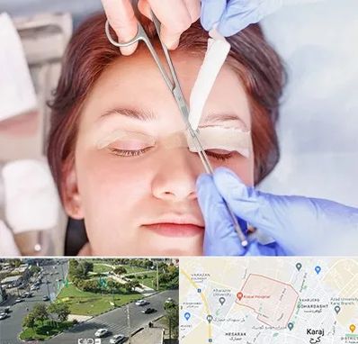 جراحی پلک افتاده در شاهین ویلا کرج