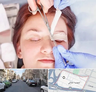 جراحی پلک افتاده در مجیدیه شمالی