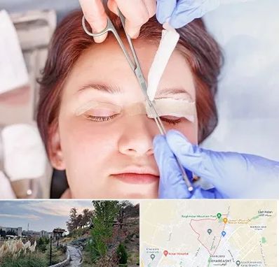 جراحی پلک افتاده در باغستان کرج