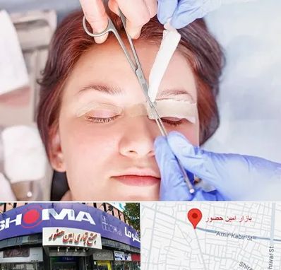 جراحی پلک افتاده در امین حضور