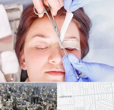 جراحی پلک افتاده در جیحون
