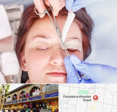 جراحی پلک افتاده در 15 خرداد