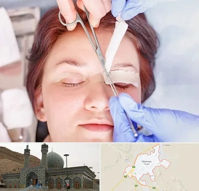 جراحی پلک افتاده در شهرضا