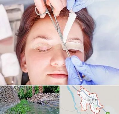 جراحی پلک افتاده در سراوان