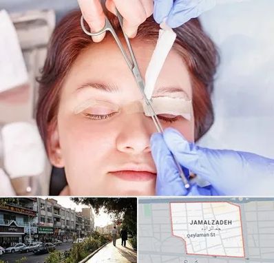 جراحی پلک افتاده در خیابان جمالزاده