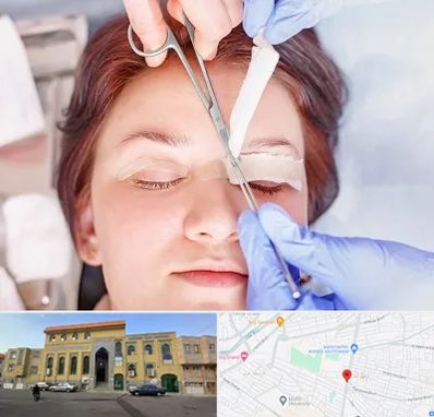 جراحی پلک افتاده در زنبیل آباد قم