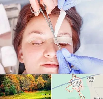 جراحی پلک افتاده در کردکوی