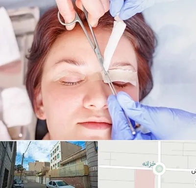 جراحی پلک افتاده در خزانه