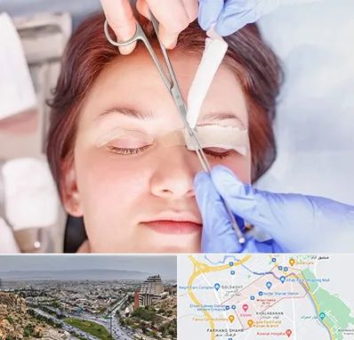 جراحی پلک افتاده در معالی آباد شیراز