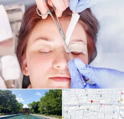 جراحی پلک افتاده در هشت بهشت اصفهان