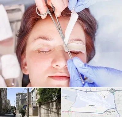 جراحی پلک افتاده در مهرآباد