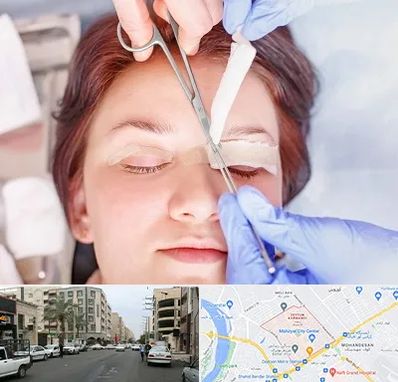 جراحی پلک افتاده در زیتون کارمندی اهواز