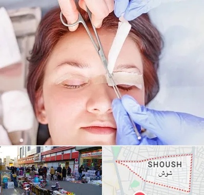 جراحی پلک افتاده در شوش