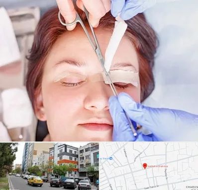 جراحی پلک افتاده در هفده شهریور تبریز