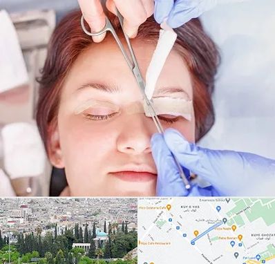 جراحی پلک افتاده در محلاتی شیراز