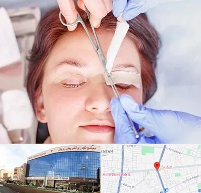 جراحی پلک افتاده در نصف راه تبریز