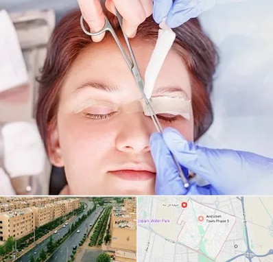 جراحی پلک افتاده در فاز سه اندیشه