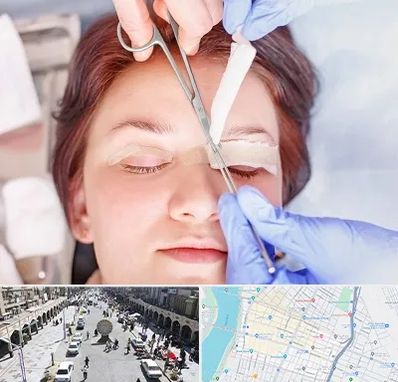 جراحی پلک افتاده در نادری اهواز